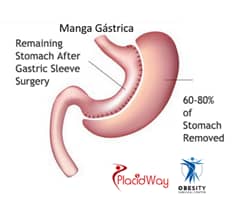 Slider image (4) Obesity Surgical Center | Dr. Jorge Reyes Mendiola